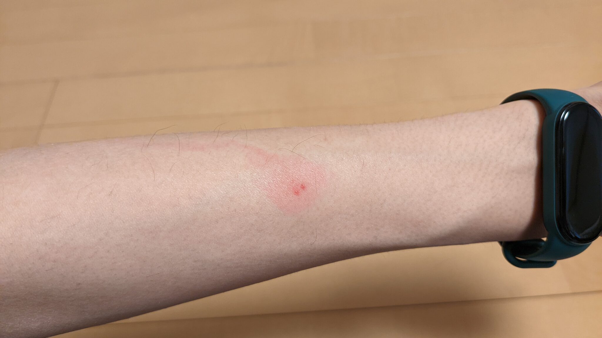 線状に現れる虫刺され